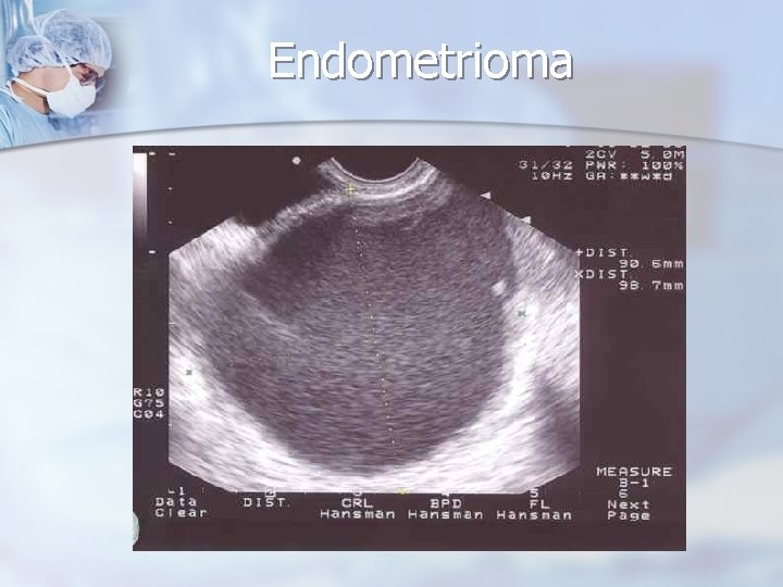 Endometrioma 