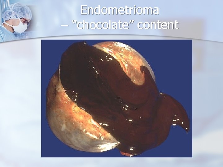 Endometrioma – “chocolate” content 