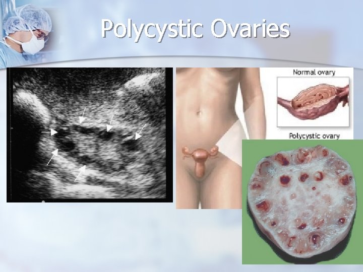Polycystic Ovaries 