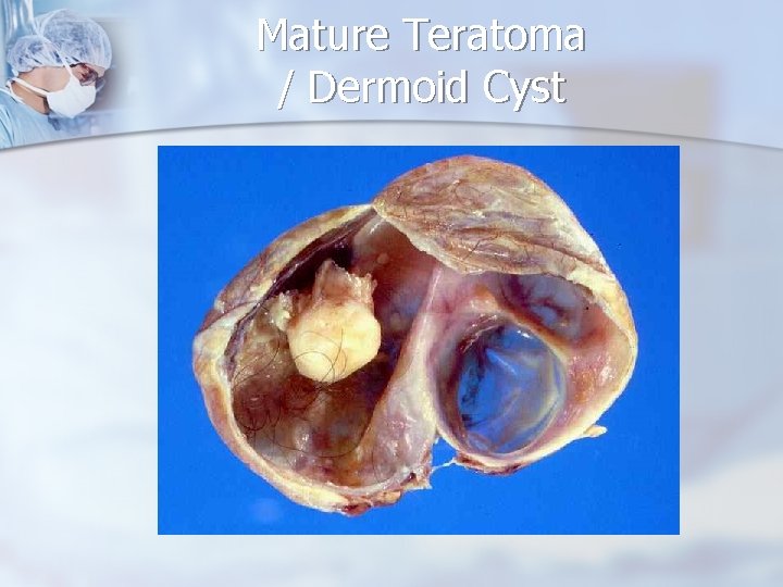 Mature Teratoma / Dermoid Cyst 