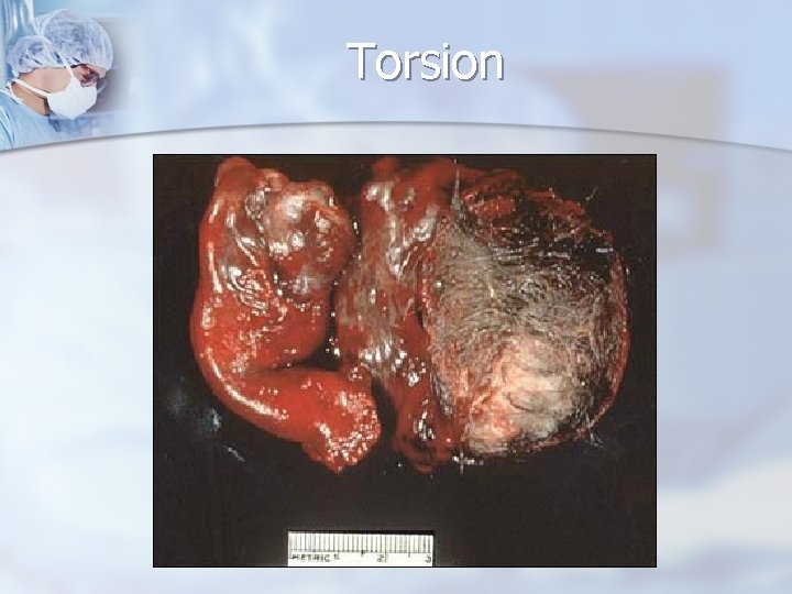 Torsion 