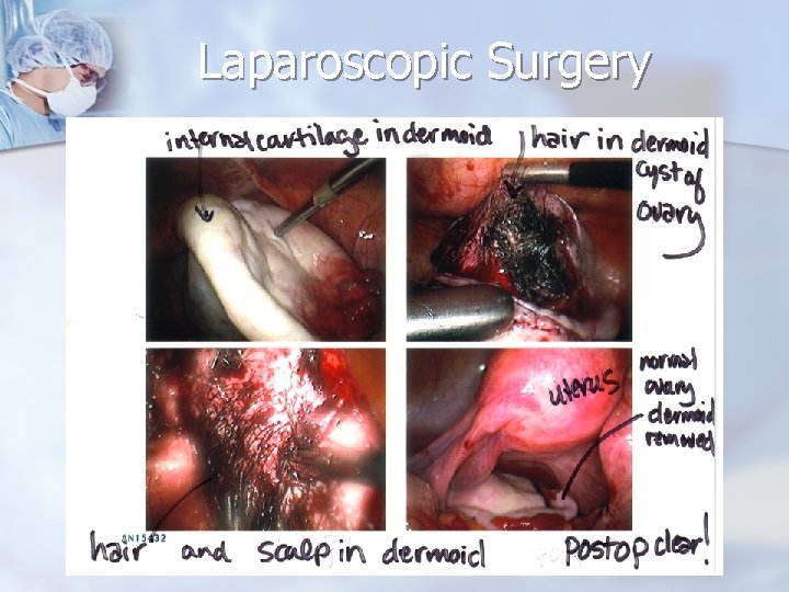 Laparoscopic Surgery 