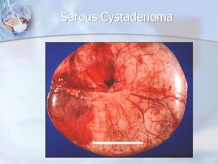 Serous Cystadenoma 