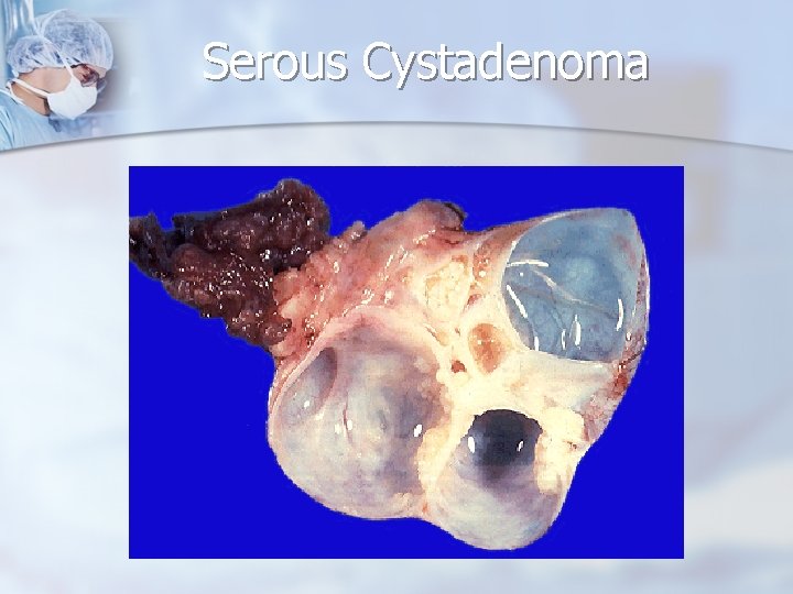 Serous Cystadenoma 