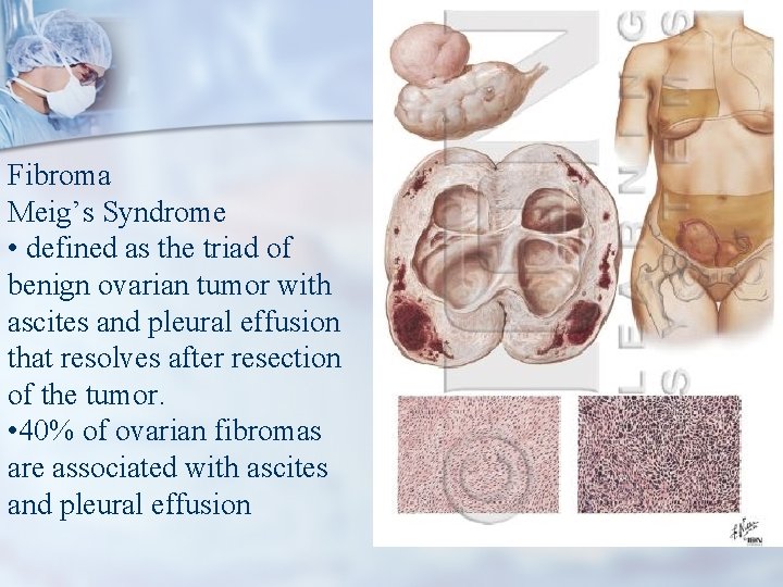 Fibroma Meig’s Syndrome • defined as the triad of benign ovarian tumor with ascites