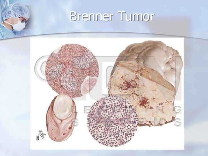 Brenner Tumor 