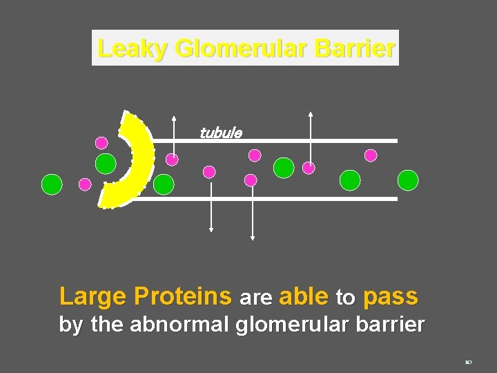 Leaky Glomerular Barrier tubule Large Proteins are able to pass by the abnormal glomerular