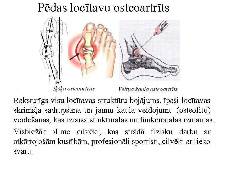 Pēdas locītavu osteoartrīts Raksturīgs visu locītavas struktūru bojājums, īpaši locītavas skrimšļa sadrupšana un jaunu