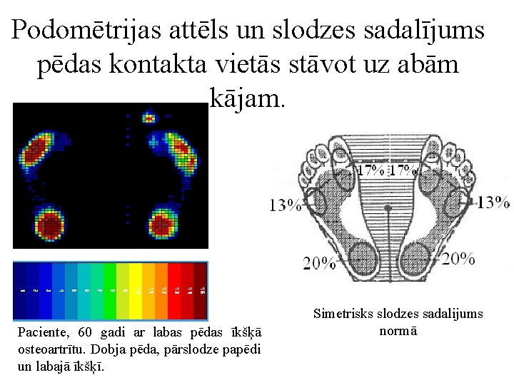 Podomētrijas attēls un slodzes sadalījums pēdas kontakta vietās stāvot uz abām kājam. Paciente, 60