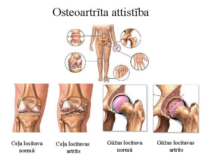 Osteoartrīta attistība Ceļa locītava normā Ceļa locītavas artrīts Gūžas locītava normā Gūžas locītavas artrīts