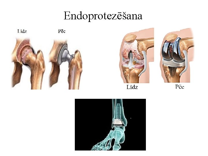 Endoprotezēšana 