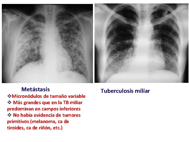 Metástasis v. Micronódulos de tamaño variable v Más grandes que en la TB miliar