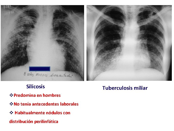 Silicosis v. Predomina en hombres v. No tenía antecedentes laborales v Habitualmente nódulos con