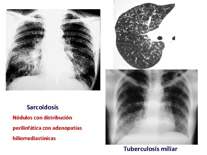 Sarcoidosis Nódulos con distribución perilinfática con adenopatías hiliomediastínicas Tuberculosis miliar 