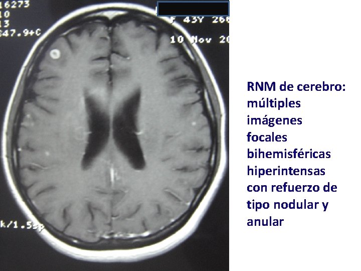 RNM de cerebro: múltiples imágenes focales bihemisféricas hiperintensas con refuerzo de tipo nodular y