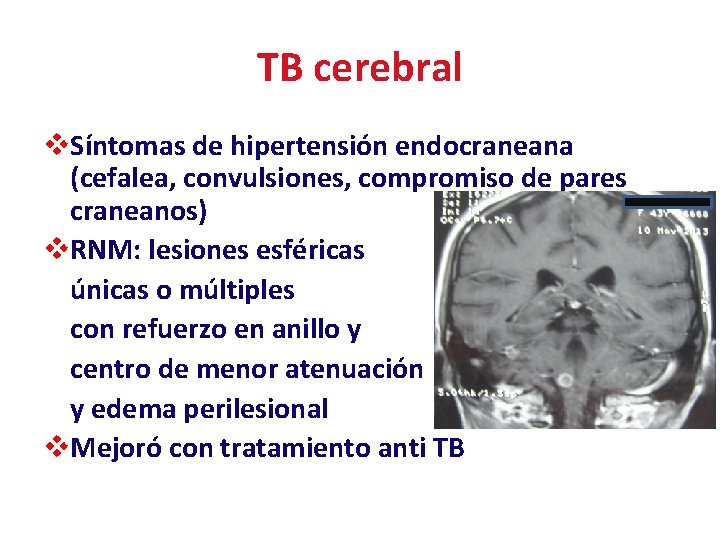 TB cerebral v. Síntomas de hipertensión endocraneana (cefalea, convulsiones, compromiso de pares craneanos) v.