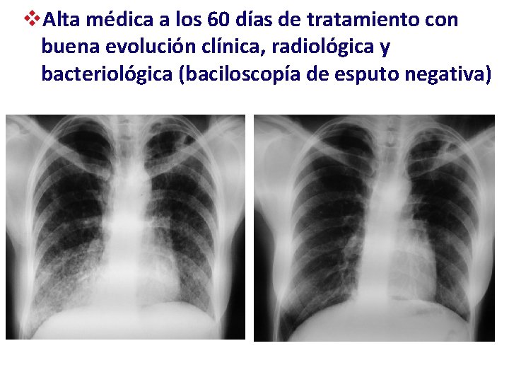 v. Alta médica a los 60 días de tratamiento con buena evolución clínica, radiológica
