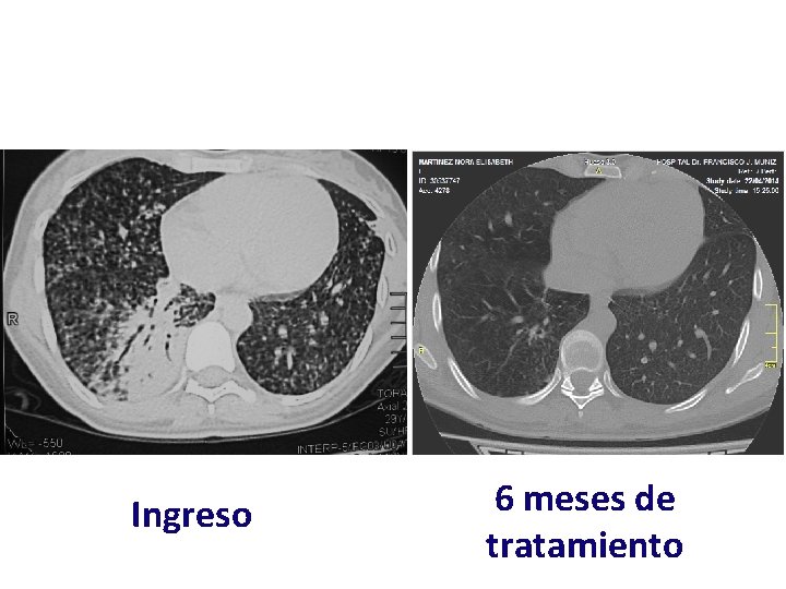 Ingreso 6 meses de tratamiento 