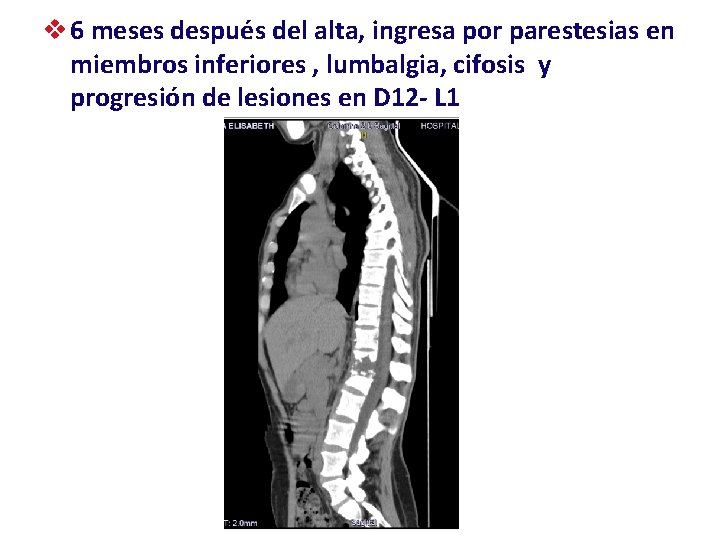 v 6 meses después del alta, ingresa por parestesias en miembros inferiores , lumbalgia,
