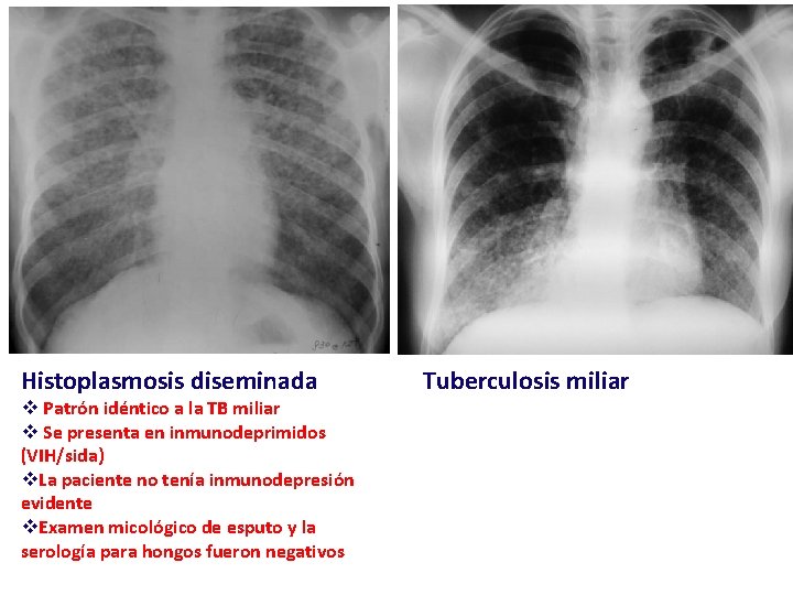 Histoplasmosis diseminada v Patrón idéntico a la TB miliar v Se presenta en inmunodeprimidos