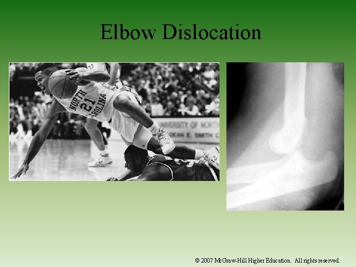 Elbow Dislocation © 2007 Mc. Graw-Hill Higher Education. All rights reserved. 