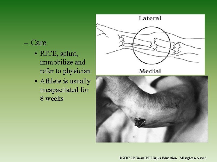 – Care • RICE, splint, immobilize and refer to physician • Athlete is usually