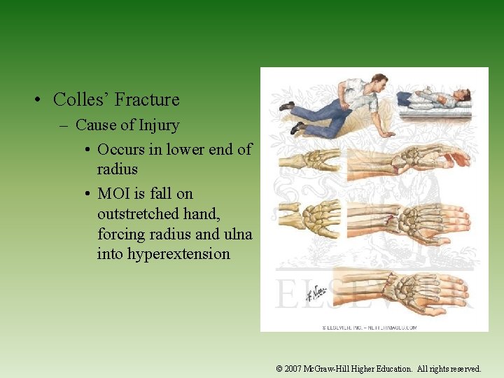  • Colles’ Fracture – Cause of Injury • Occurs in lower end of