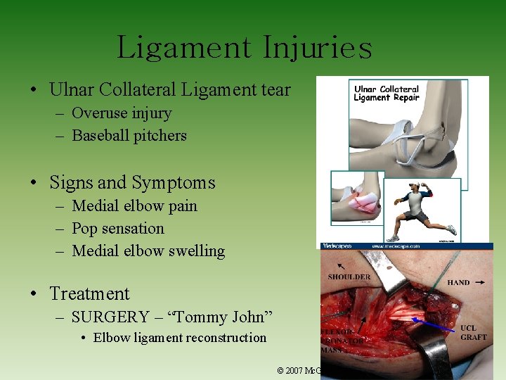 Ligament Injuries • Ulnar Collateral Ligament tear – Overuse injury – Baseball pitchers •