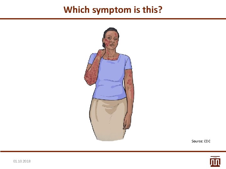 Which symptom is this? Source: CDC 01. 10. 2018 