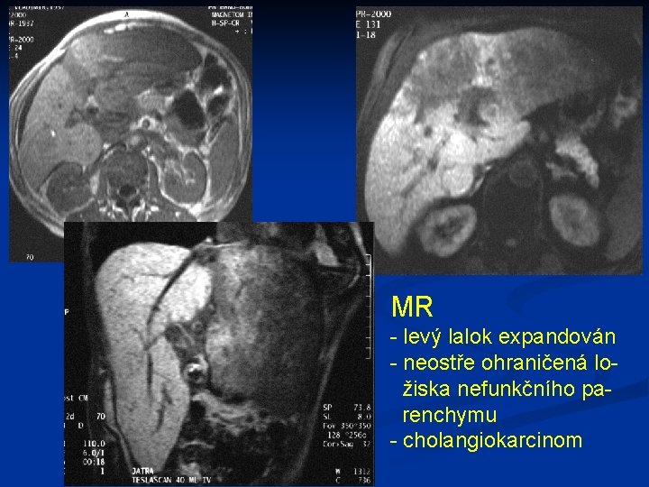 MR - levý lalok expandován - neostře ohraničená ložiska nefunkčního parenchymu - cholangiokarcinom 