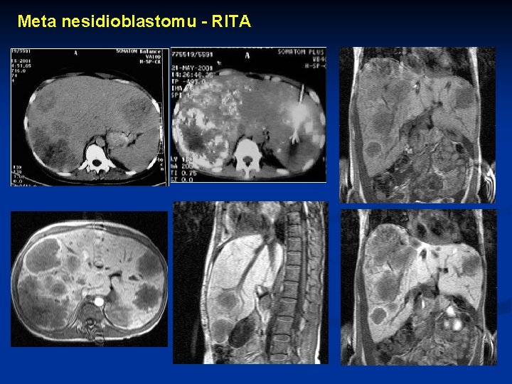 Meta nesidioblastomu - RITA 