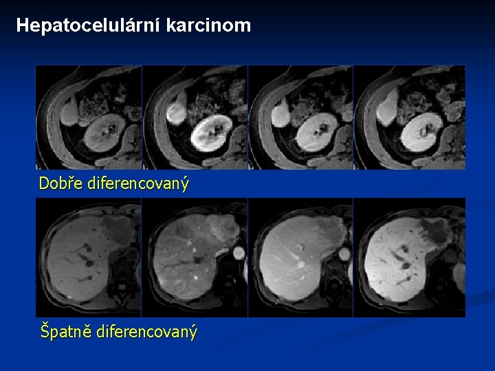 Hepatocelulární karcinom Dobře diferencovaný Špatně diferencovaný 
