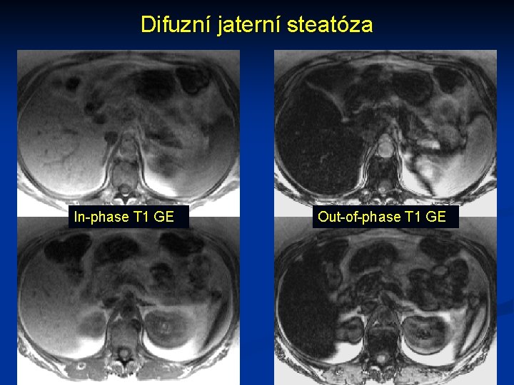 Difuzní jaterní steatóza In-phase T 1 GE Out-of-phase T 1 GE 