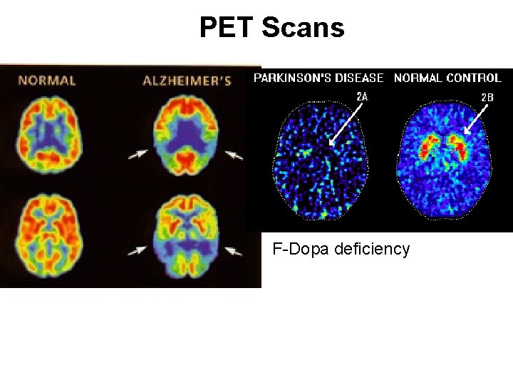 PET Scans F-Dopa deficiency 