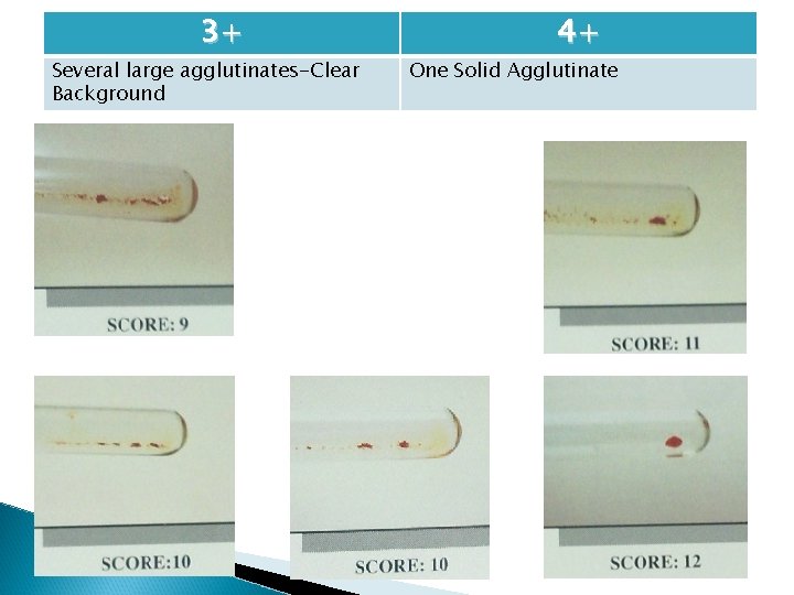 3+ Several large agglutinates-Clear Background 4+ One Solid Agglutinate 