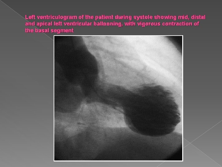 Left ventriculogram of the patient during systole showing mid, distal and apical left ventricular