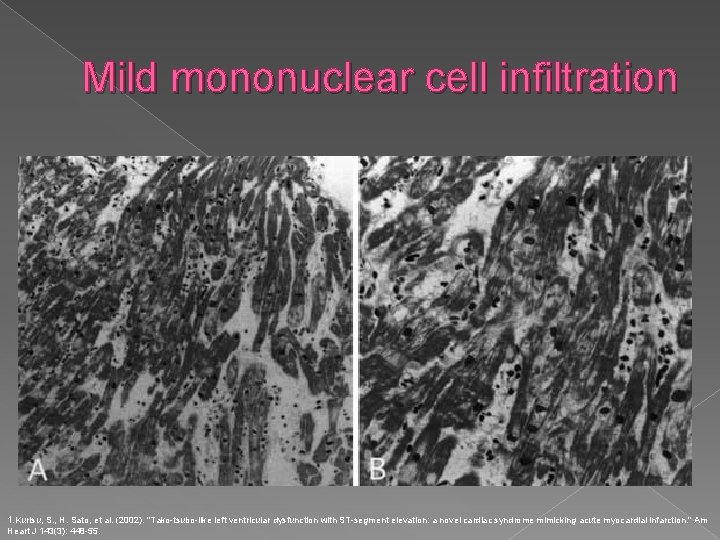 Mild mononuclear cell infiltration 1. Kurisu, S. , H. Sato, et al. (2002). "Tako-tsubo-like