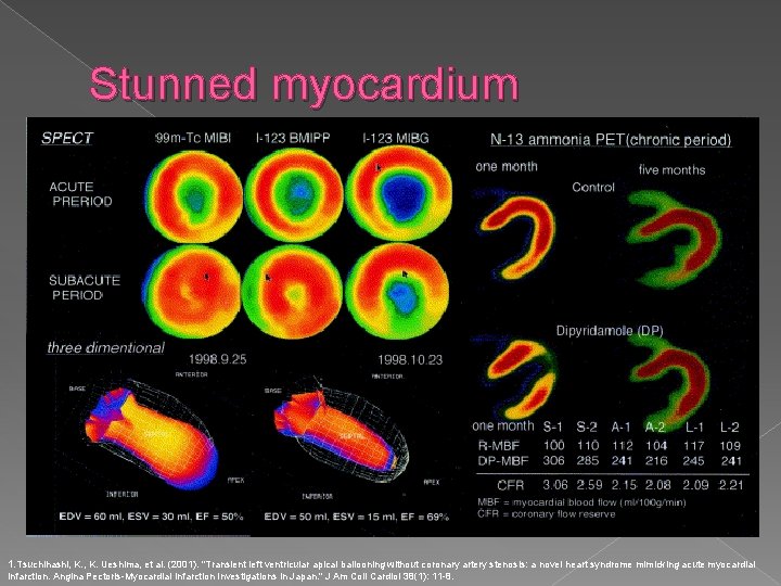 Stunned myocardium 1. Tsuchihashi, K. Ueshima, et al. (2001). "Transient left ventricular apical ballooning
