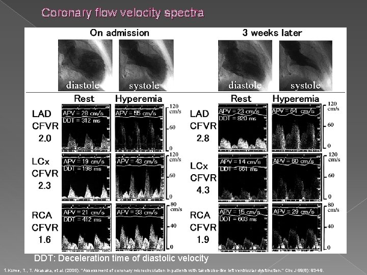 Coronary flow velocity spectra DDT: Deceleration time of diastolic velocity 1. Kume, T. Akasaka,