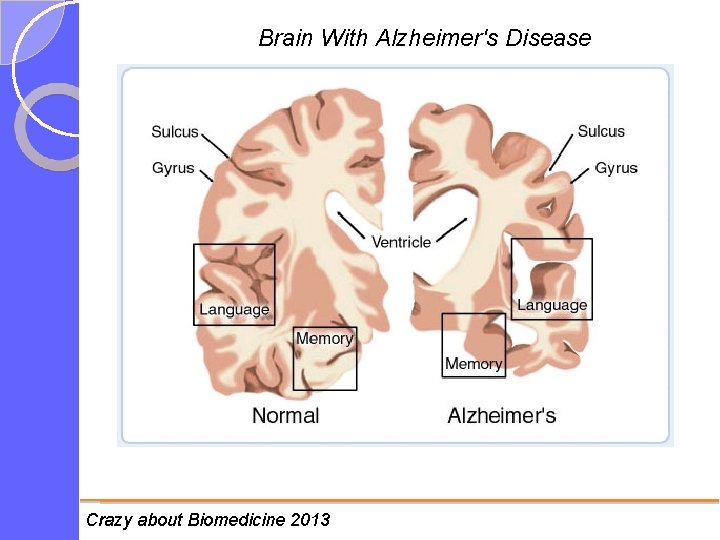 Brain With Alzheimer's Disease Crazy about Biomedicine 2013 