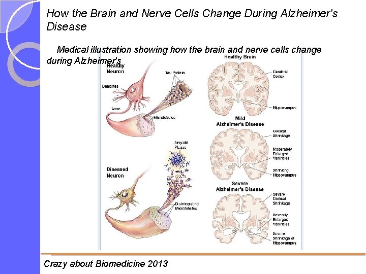 How the Brain and Nerve Cells Change During Alzheimer's Disease Medical illustration showing how