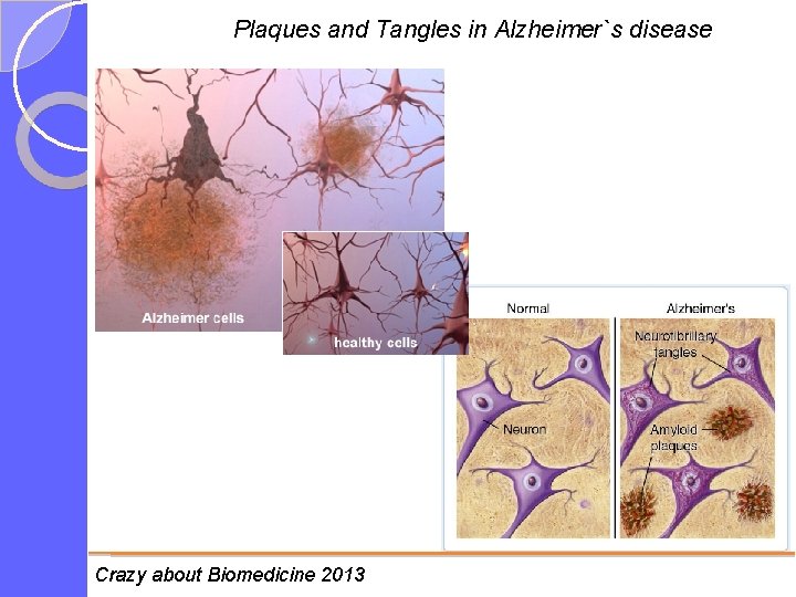 Plaques and Tangles in Alzheimer`s disease Crazy about Biomedicine 2013 