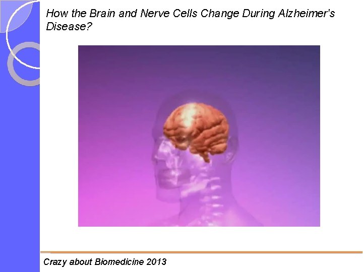 How the Brain and Nerve Cells Change During Alzheimer's Disease? Crazy about Biomedicine 2013