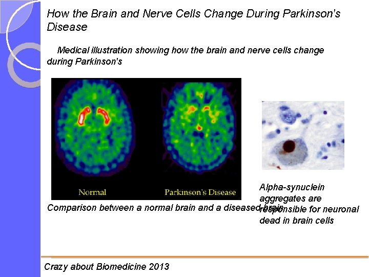 How the Brain and Nerve Cells Change During Parkinson's Disease Medical illustration showing how