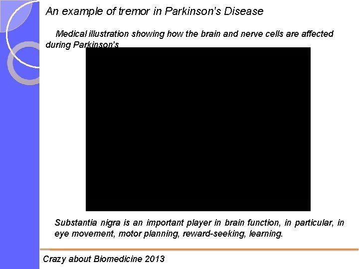 An example of tremor in Parkinson's Disease Medical illustration showing how the brain and