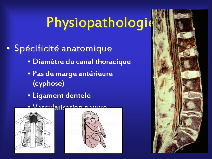 Physiopathologie • Spécificité anatomique • Diamètre du canal thoracique • Pas de marge antérieure