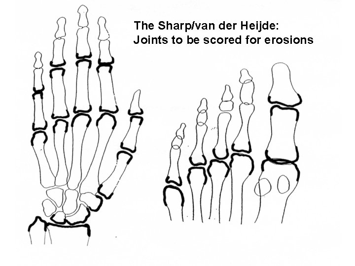 The Sharp/van der Heijde: Joints to be scored for erosions 