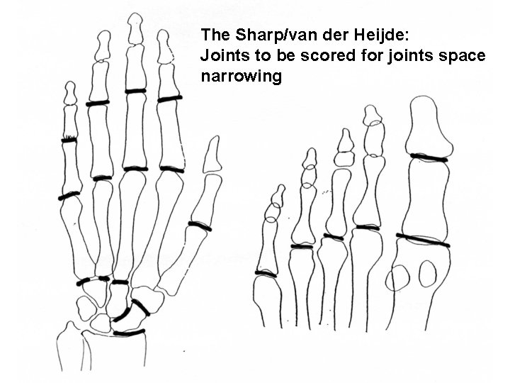 The Sharp/van der Heijde: Joints to be scored for joints space narrowing 