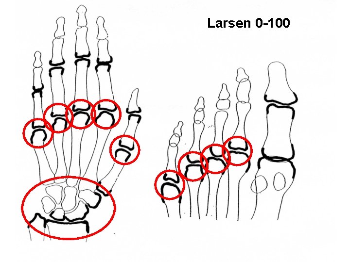 Larsen 0 -100 