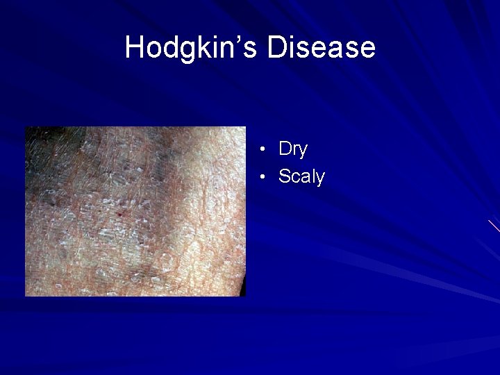 Hodgkin’s Disease • Dry • Scaly 